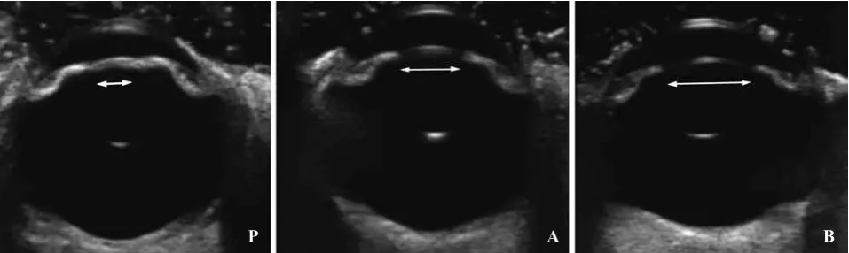 Fig. 3: Region of Interest (ROI) delineation in the examined eyes. Lens and ciliary body areas (A) and total ocular areas (B) are delineated on B-scan images and the borders are automatically transposed on shear-wave elastographic images by the Aixplorer s