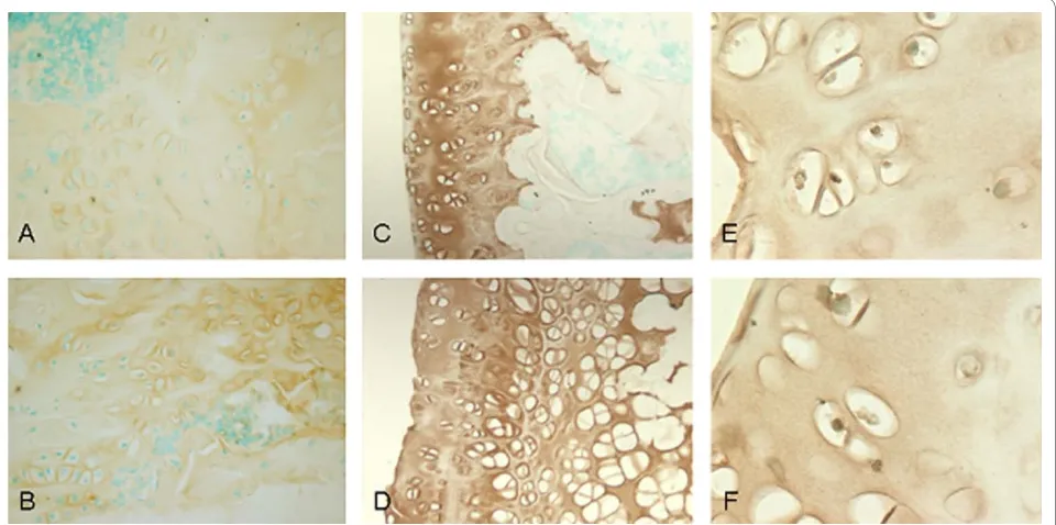 Figure 2 Upregulation of A2M surface protein expression in steroid-induced early ANFH