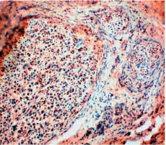 Fig. 3 A,B:A: Neurofilaments, normal nerve bundles and cross section of two bundles at medium magnification (thick sections).Specific (IHC) axon demonstration, adjacent fibrous-fat structures remain negative