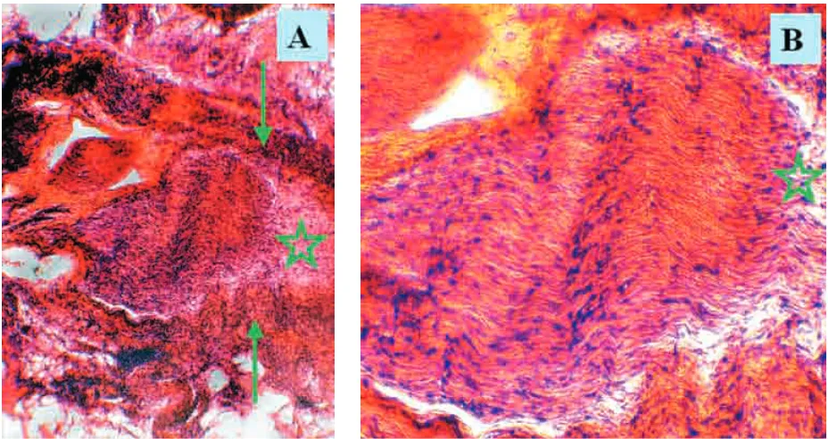 Fig. 5A,B:A,B: The same situation as in Fig. 4 using the thick section stained with HE