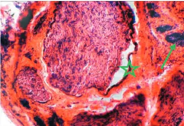 Fig. 7: Focal regression inside heavily affected nerve bundle, which might be of ischemic origin leading to possible oblite-ration of nutritive vessels at the site of adjacent plastic reaction (a thick section, HE staining, medium magnification).Group III.
