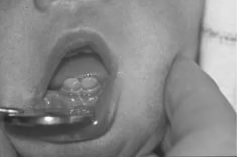 Fig. 2: Teeth after extraction.