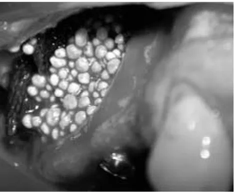 Fig. 1: SMP occurred during the lateral wall osteotomy.