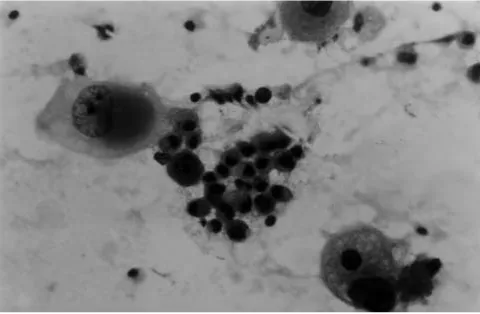Fig 1: Low-grade MEC: Macrophage-like cells. FNA. Papanicolaou X400.