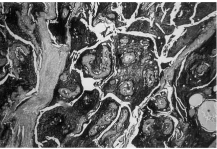 Fig 4: Low-grade MEC: Large mucous cells forming various sized cystic structures. Tissue sectionH-E X100.