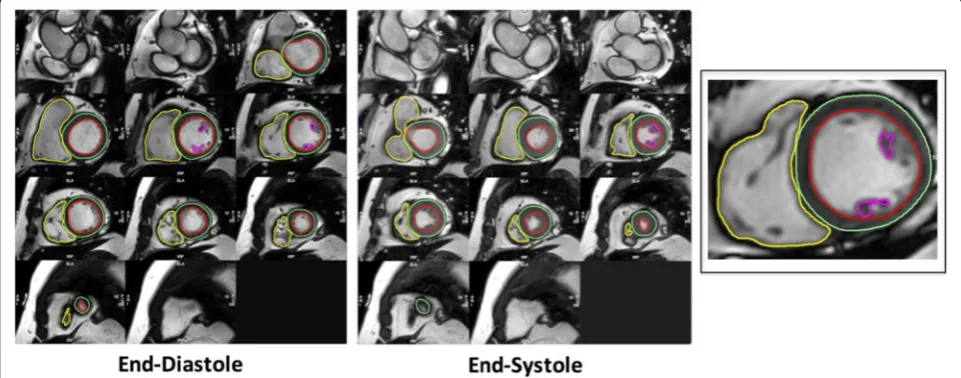 Fig. 1 Contouring of Left and Right Ventricles in Diastole and Systole. Endo- and epicardial borders of the left ventricle were contoured inend-diastole and end-systole