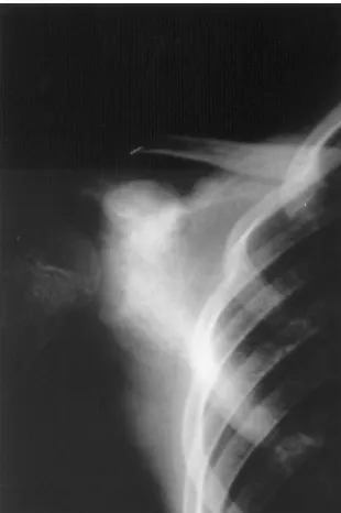 Fig. 12a: Chronic osteomyelitis of the scapula involving theacromion, the spina and extending into the body of the sca-pula