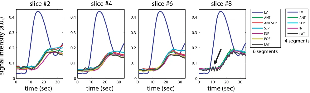 Figure 7Time intensity curves in a healthy volunteermal perfusion. Flickering artifacts caused by errors in coil sensitivity map estimation were observed (see an arrow in the 8and 8Time intensity curves in a healthy volunteer