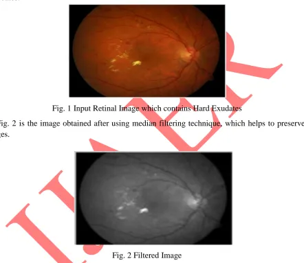 Fig. 1 is the input retinal image obtained from messidor dataset, which contains hard exudates