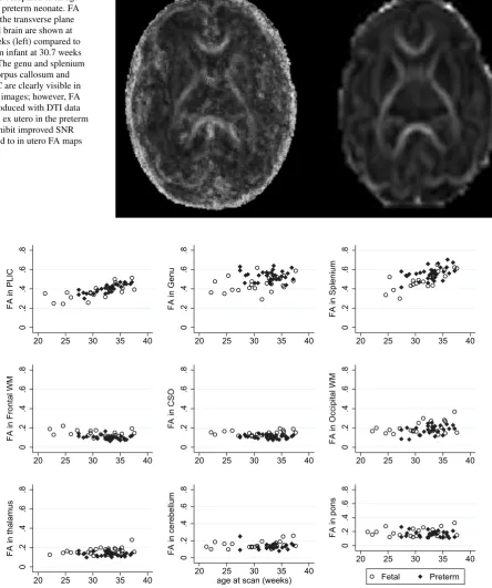 Fig. 7  FA maps in a fetus at 30 weeks compared to an age-matched preterm neonate. FA maps in the transverse plane of a fetal brain are shown at 30.5 weeks (left) compared to a preterm infant at 30.7 weeks (right)
