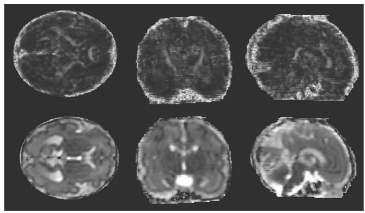 Table 2  FA and ADC values from tractography