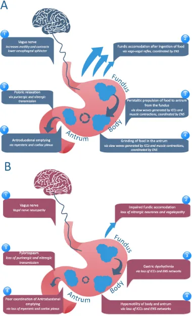 Figure 1.  Gastric function in normal state (A) and in diabetic gastroparesis (B).  A number of coordinated neuronal and myenteric processes are needed for normal coordinated gastric emptying