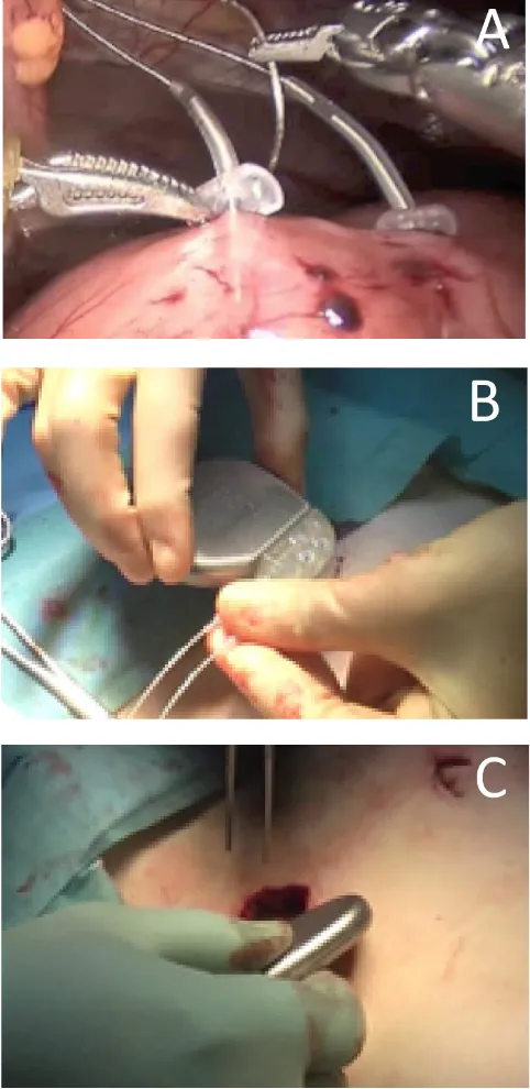 Figure 4.  Surgical implantation of a gastric electrical stimulator. Panel A demonstrates suturing of the electrodes to the anterior wall of the antrum