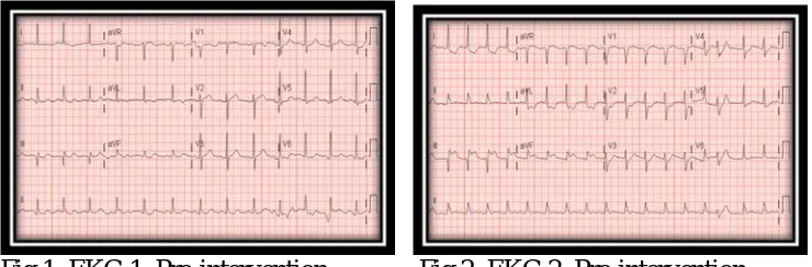 Fig 1. EKG 1. Pre-intervention              Fig 2. EKG 2. Pre-intervention     