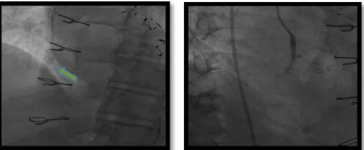 Fig 3. SVG to PDA graft, Pre-intervention 