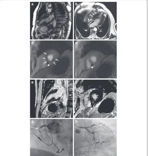 Fig. 2 Adenosine stress CMR and subsequent coronary angiogram in a patient with AV block, suspected coronary artery disease and pathologicvisible (asterixes)