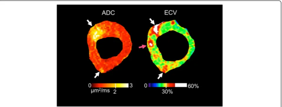 Fig. 6 Representative example of a discordant segment (anteroseptal) between ADC and ECV