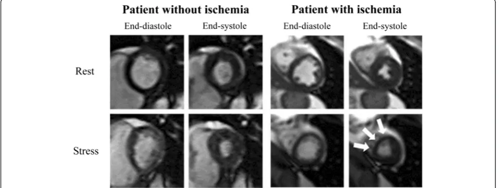 Fig. 2 Rest and Stress CMR Images of the Left Ventricle in the Short-Axis View. Cine CMR images of the left ventricle in the mid-short axis view atend-diastole and end-systole during rest (top row) and after maximal upright treadmill exercise stress (botto