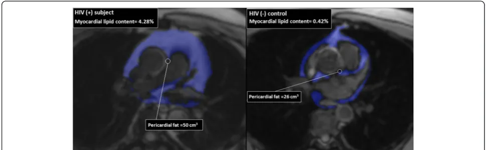 Fig. 1 Pericardial fat volume quantification at level of the LM origin. On the right, 49 year old HIV (+) subject with BMI 24 kg/m2 and 27 years onHAART, quantification on CMR revealed a high pericardial fat volume and myocardial lipid content