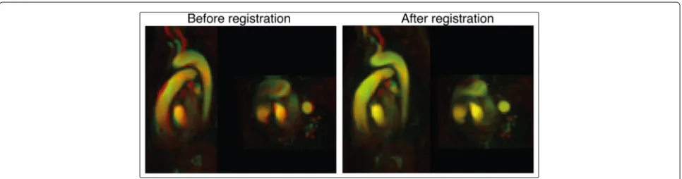 Fig. 3 Registration of PC-MRAs. Sagittal and transverse planes of PC-MRA images of two different datasets before and after registration