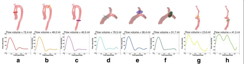 Table 2 Net flow volumes obtained in the ascending aorta using3 different approaches: semi-automatic, automatic, andautomatic segmentation on the same plane located duringmanual segmentation (mean ± standard deviation)