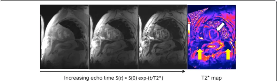 Fig. 3 Cardiac T2* Imaging. Multiple images obtained from increasing echo time points (3 time points shown from the left) can be combined tocreate a T2* map (final image on the right)