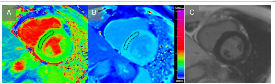 Fig. 1 Native and post contrast T1 mapping and LGE imaging in hypertension. Basal short axis T1 maps acquired pre-contrast (a) and postcontrast (b) with ShMOLLI
