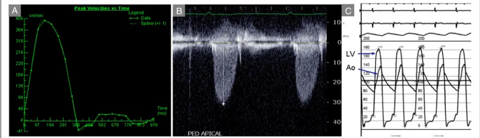 Fig. 6 Aortic Stenosis.ting of 250 cm/s shows extensive aliasing, suggesting the peak velocity is considerably higher than 2.5 m/s.d a Systolic frame from a balanced SSFP cine CMR acquisition in the left ventricular outflow tract plane shows a turbulent je