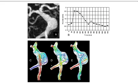 Fig. 13 Giant fusiform basilar aneurysm: geometric and flow boundary conditions, and CFD predicted velocity fields for three different flowconditions