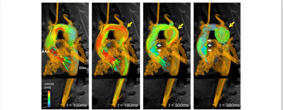 Fig. 5 Development of vortical flow patterns in the thoracic aorta in a patient with a tubular shaped aortic arch and an aneurysm of the proximaldescending aorta (yellow arrow, diameter = 4.2 cm)