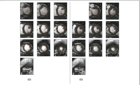 Fig. 1 Estimated consensus contours from a myocardial infarction case
