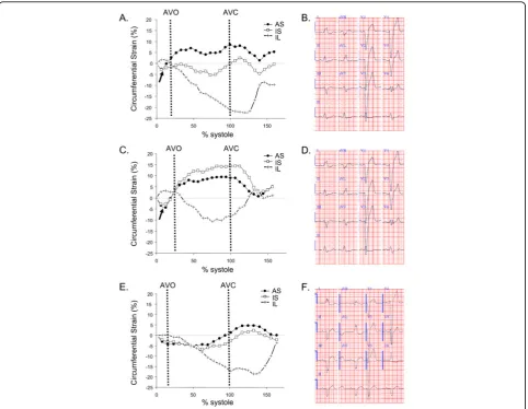 Figure 2 Three different septal circumferential strain patterns in patients with LBBBCorresponding ECG, QRS = 156 ms
