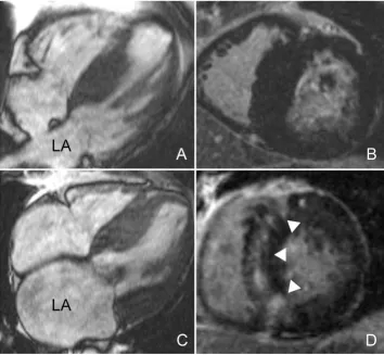 Figure 2HCM patients with comparable left ventricular mass and different left atrial sizecine imagesHCM patients with comparable left ventricular mass and different left atrial size