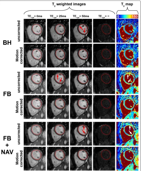 Fig. 1 T2 scans from one subject acquired using the T2P4TE sequence under breath-hold (BH), free breathing (FB), and free breathing withrespiratory navigator gating (FB + NAV)