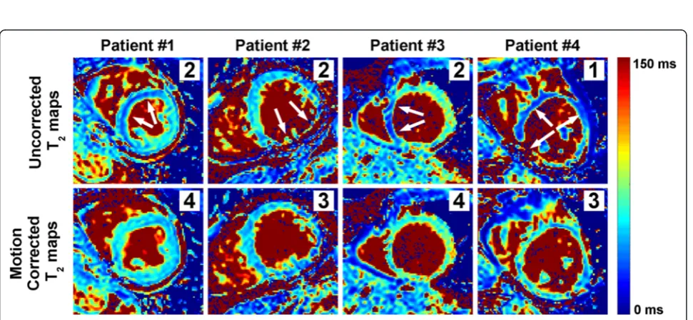 Fig. 5 Spatial variability of T2 mapping in all subjects using the T2P20TE sequence acquired under free breathing conditions with respiratory navigatorgating