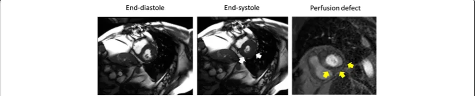 Figure 1 Discordance between left ventricular wall motion abnormalities and perfusion defects indicative of inducible myocardialischemia