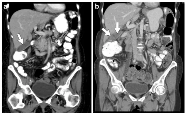 Fig. 14 A 60-year-old femalebladder lumen.contrast-enhanced CT 6 monthslater shows progression oftumefactive sludge (enhancing mildly thickenedgallbladder wall changes,with recurrent ovarian cancertreated with a multi-drugchemotherapy regimen, whichinclude