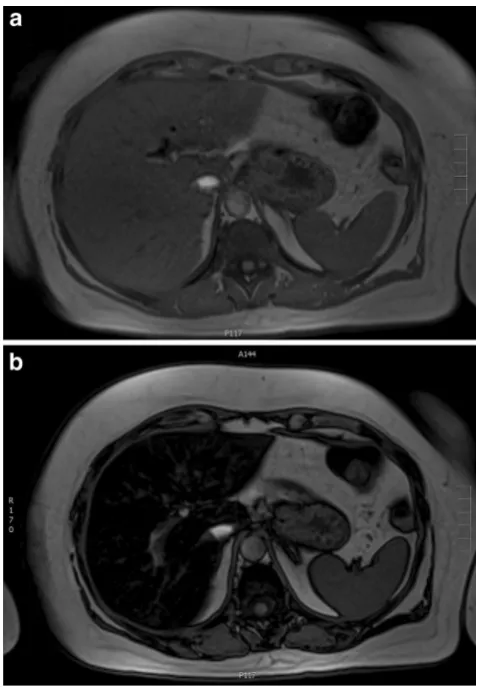 Fig. 2 A 60-year-old female with colorectal cancer currently beingtreated with irinotecan