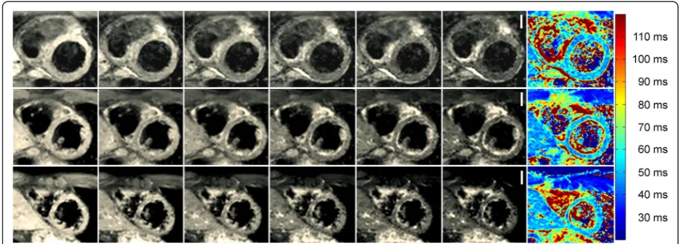 Figure 2 Results of the six-echo GraSE sequence with corresponding T2 maps for a healthy 37-year-old male