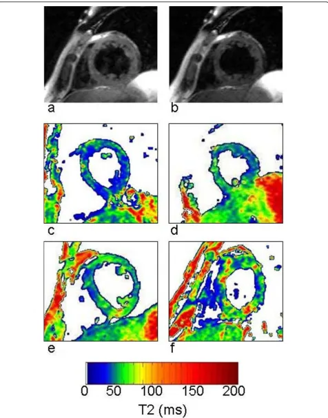 Figure 2 Left Ventricular T2 Maps. Black blood fast spin echo images of the left ventricle at TE = 6 ms (a) and TE= 34 ms (b) in the short axisview of a DMD subject
