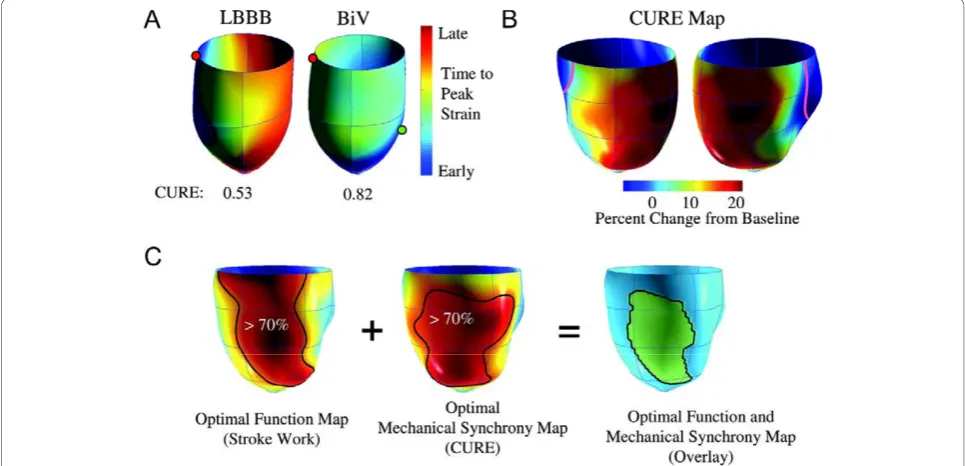 Figure 7 Dyssynchrony indexes and regional distribution of wall motion. Schematic representation of net dyssynchrony based on spatialdistribution of delayed activation