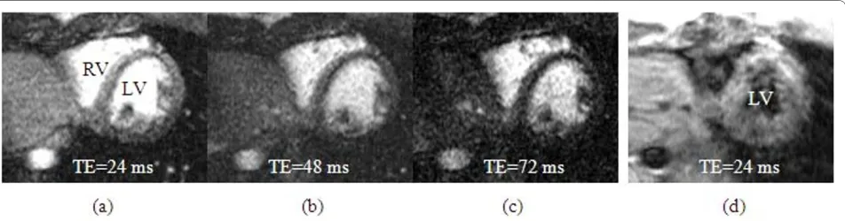 Figure 3 Examples of bright blood T2-weighted myocardial images at three different TEs, obtained from a volunteer during the adenosine infusion