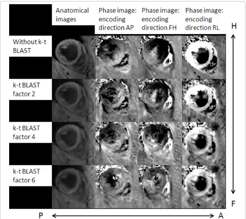 Figure 1 exemplarily shows anatomical and velocityencoded images of the myocardium acquired withoutand with k-t BLAST acceleration applying accelerationfactors of two, four and six