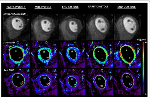 Figure 1 Case example: quantitative perfusion CMR throughout the cardiac cycle.healthy volunteer acquired at 5 different time points throughout the cardiac cycle in a single mid-ventricular slice facilitated by 8-fold This example shows stress perfusion CM