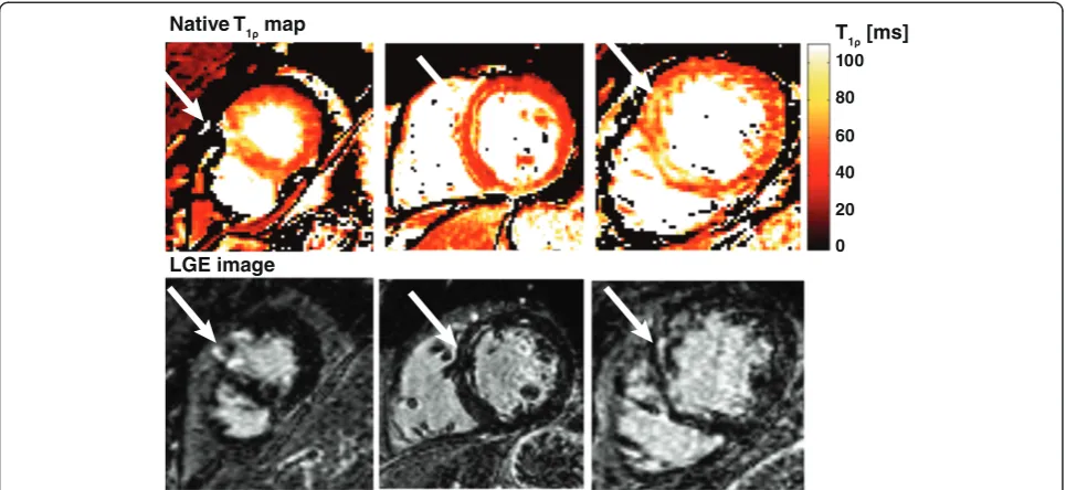 Figure 6 Short axis T1ρ-maps with corresponding LGE images in 3 different patients. Arrows indicate the infarcted area.