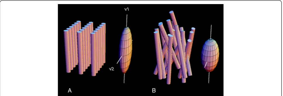 Figure 2 Schematic representation of architecture of fibers and sheets of normal myocardium (A) and in myocardial fiber disarray (B),distinctiveness is reduced or lost in fiber disarray