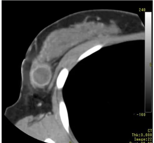 Figure 1Computed tomography scan imaging (CT) of the tumorComputed tomography scan imaging (CT) of the tumor