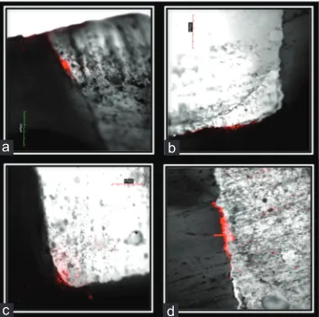 Figure 1: Scoring criteria for the depth of penetration of dye at the tooth restoration interface[24]