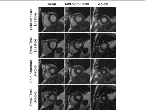 Figure 2 Example images from a patient acquired using both the gold-standard breath-hold and ECG-gated cine (first and third rows)and the real-time imaging technique (second and fourth rows) for three different slice locations in both end-diastole and end-