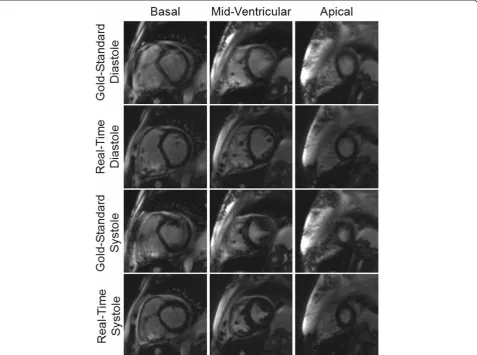 Figure 3 Example images from a subject with arrhythmia and prolonged breath-hold acquired using both the gold-standard breath-holdand ECG-gated cine (first and third rows) and the real-time non-gated and free-breathing imaging technique (second and fourth 